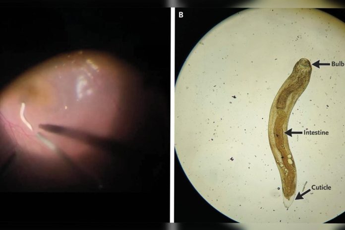 Foto colorida de parasita encontrado dentro do olho ao lado de uma ilustração do corpo do verme - Metrópoles.
