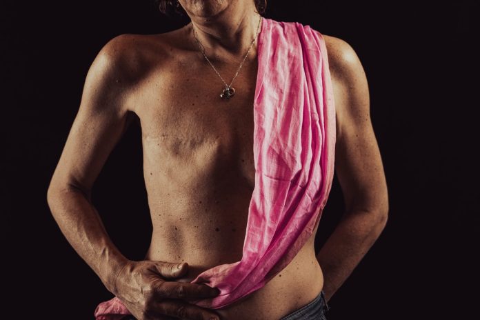 Foto colorida de mulher sem uma mama com pano rosa ao lado e uma cicatriz para representar a reconstrução da mama - Metrópoles. 