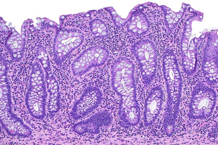 Imagem de microscópio mostra o tecido do intestino na doença inflamatória intestinal - Metrópoles